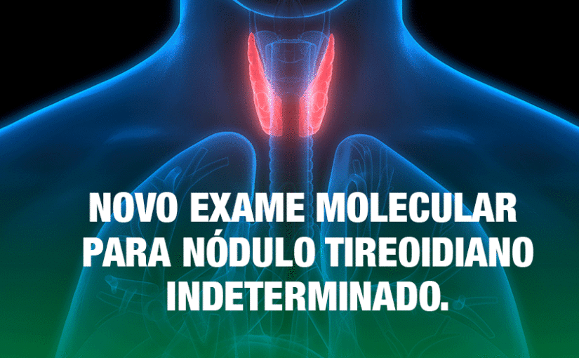 Novo exame molecular para nódulo tireoidiano indeterminado